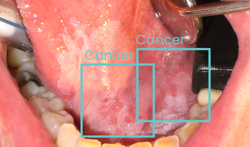 Oral Cancer Screening App