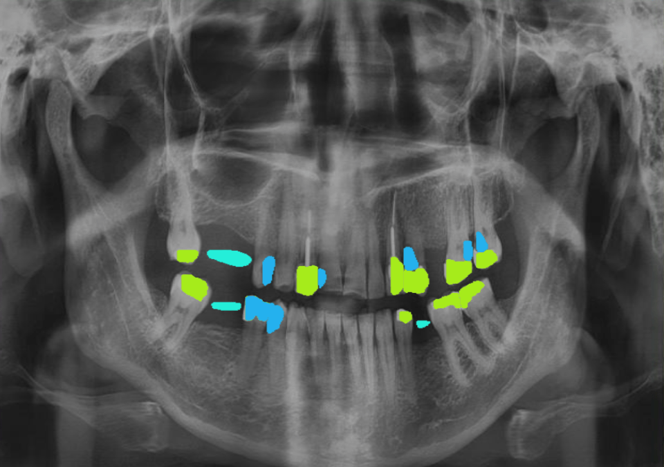 xray of a mouth